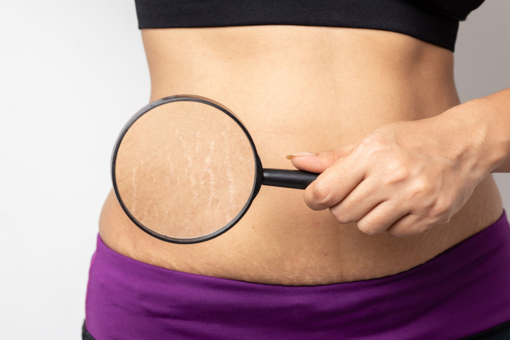 Body Perfect Yosun Peeling Seti ile Gebelik Sonrası Lekeler Nasıl Azaltılabilir? 2