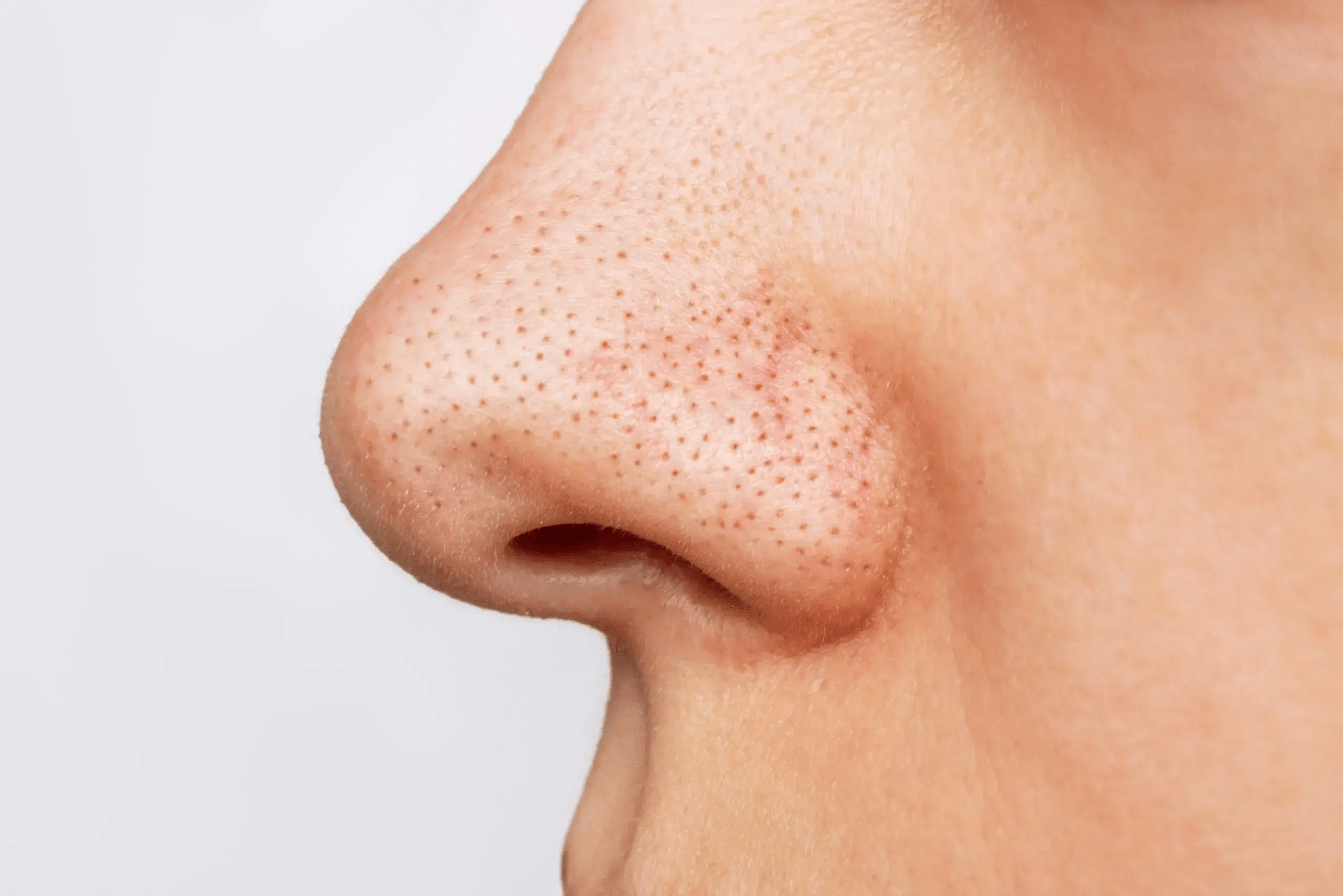 Retinol Komedonlara İyi Gelir Mi? 1