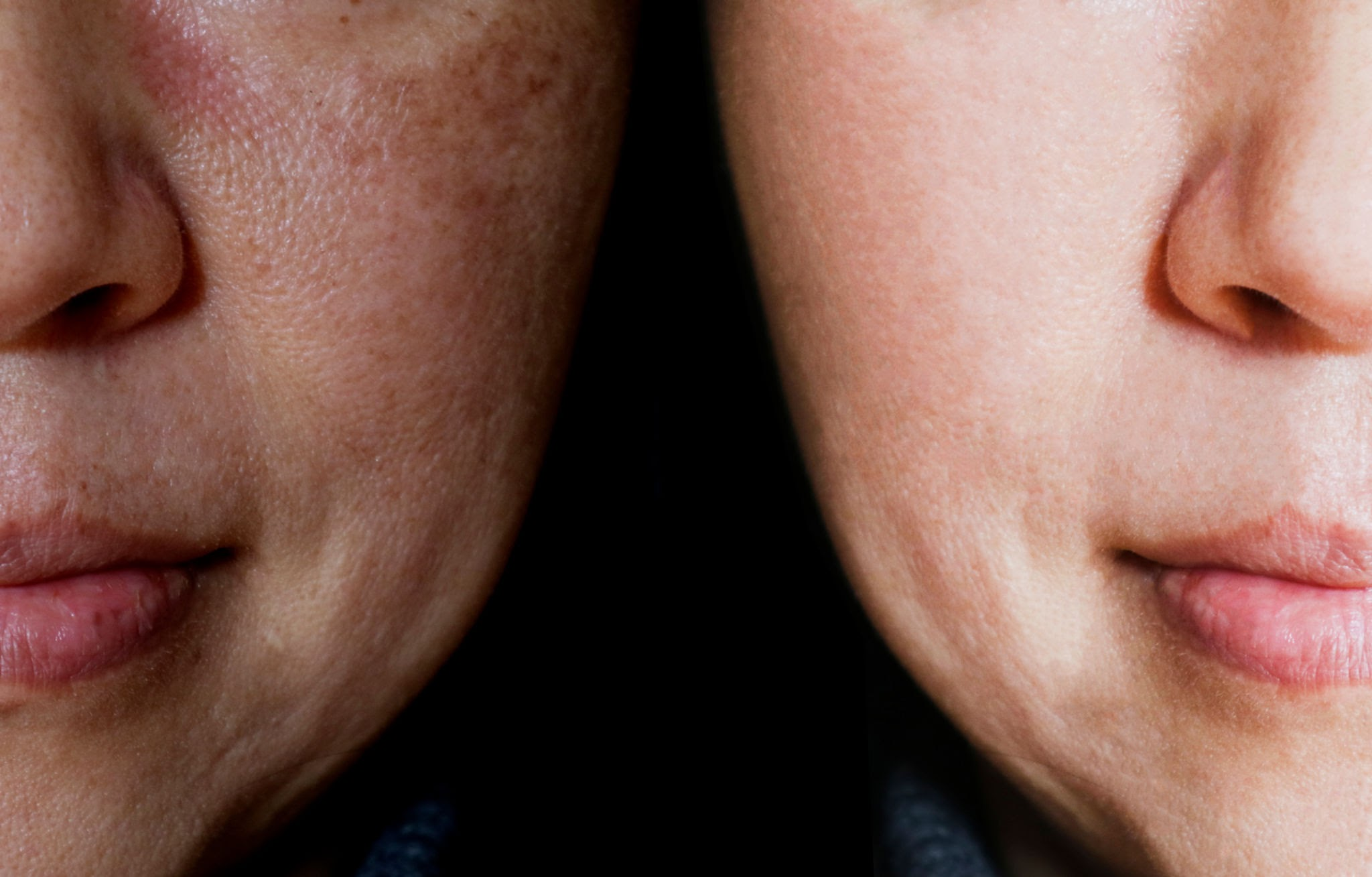 Vitiligo Olmayan Beyaz Lekeler Nasıl Geçer? Evde Çözüm Önerileri 1