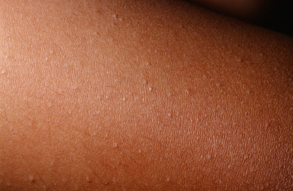 Vitiligo Olmayan Beyaz Lekeler Nasıl Geçer? Evde Çözüm Önerileri 2