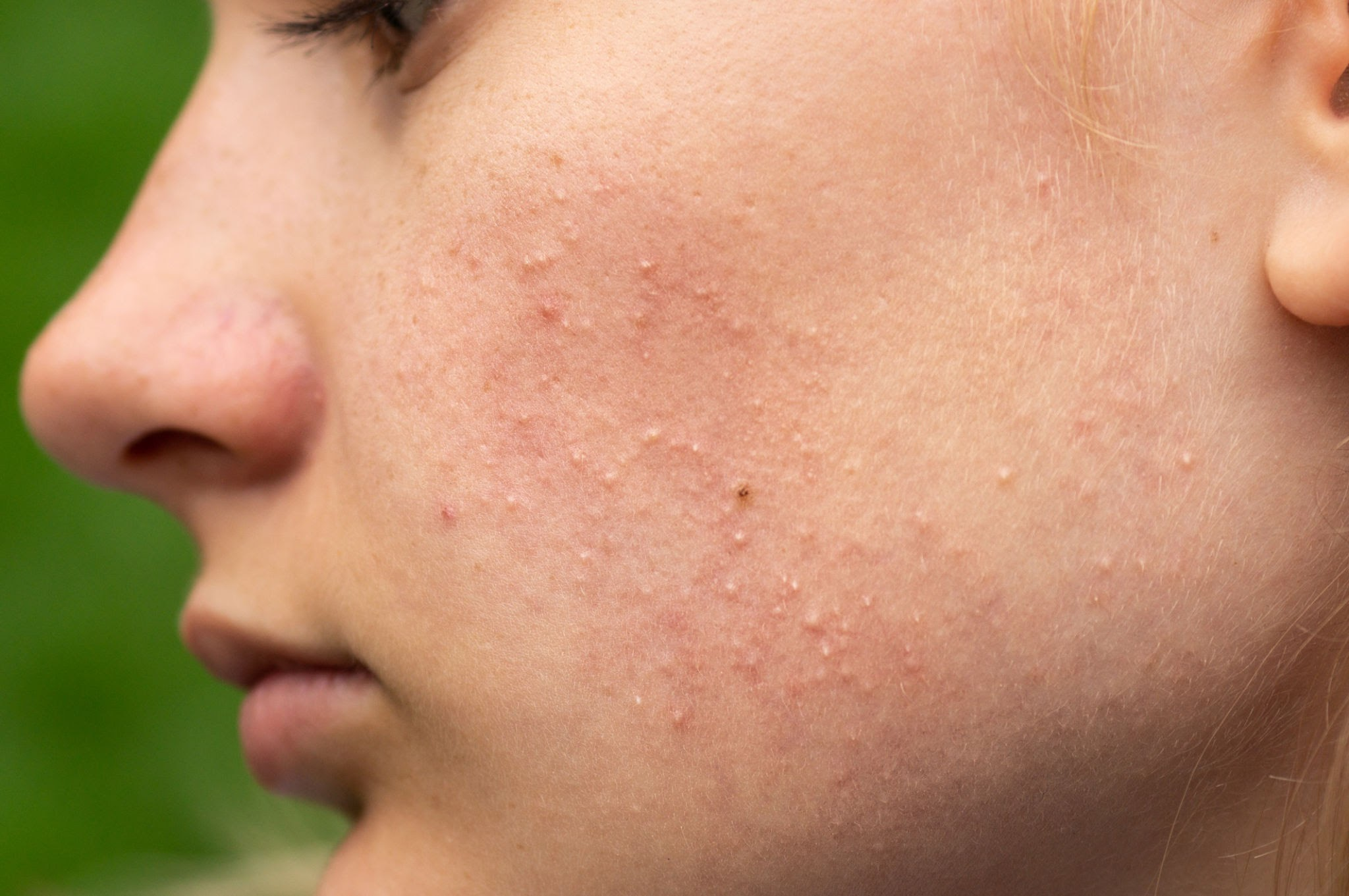 Komedonlarla Savaş Başladı! Yosun Peeling ile Cildinizdeki Devrimi Görün 1