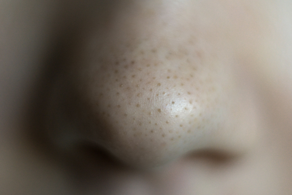 Komedon Nedir? Ciltte Görülen Siyah Noktalar