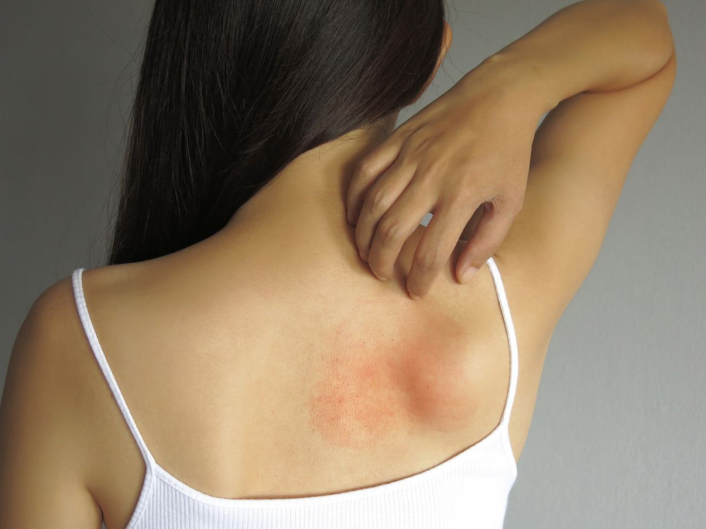 Yosun Peeling Sedef Hastalığına İyi Gelir Mi? Régnee Body Perfect ile Cilt Yenileme 1