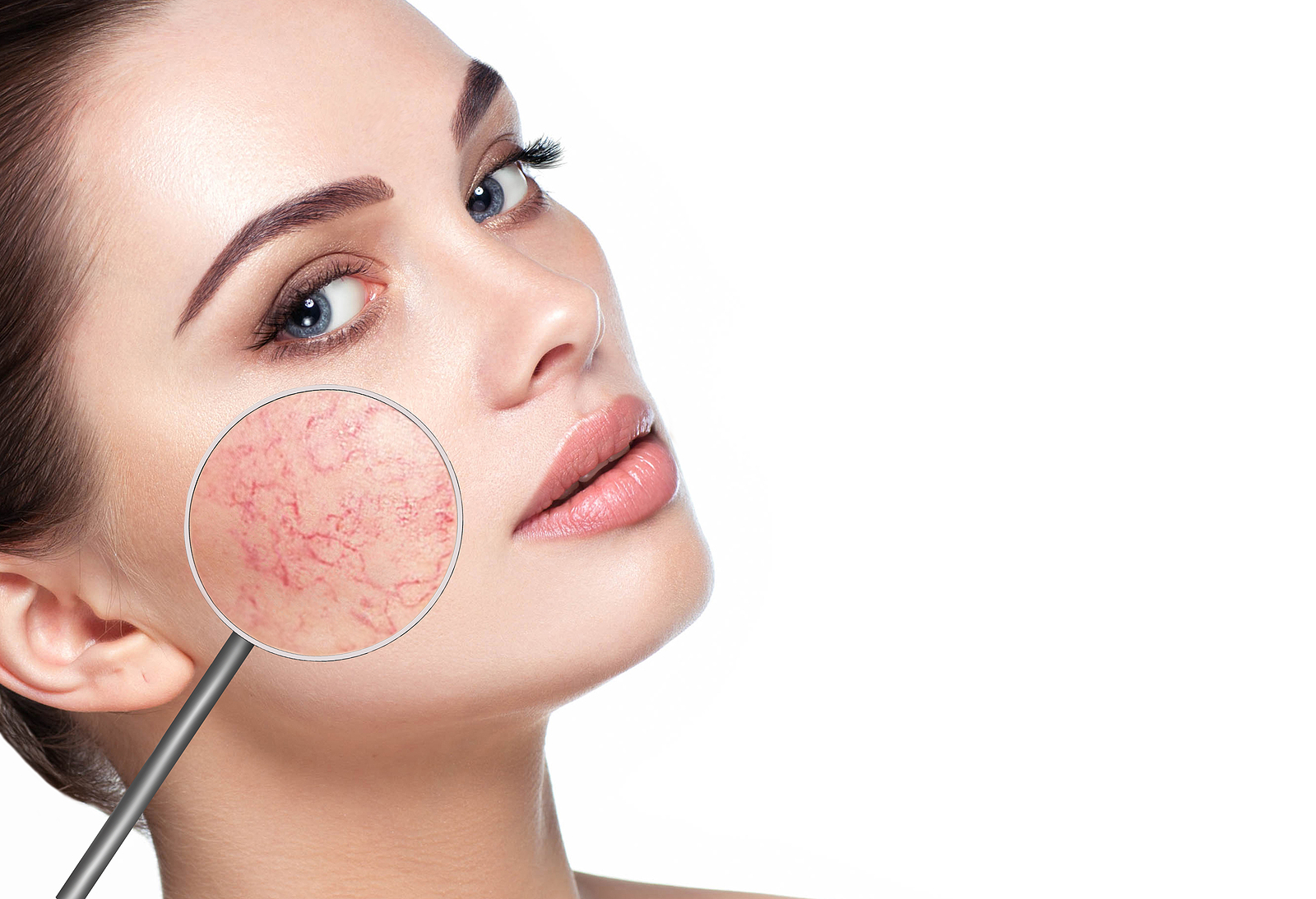 Yosun Peeling Roza Hastalığına İyi Gelir mi?
